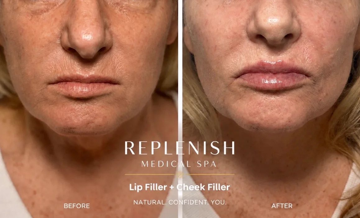 Lip and cheek filler before and after at Replenish