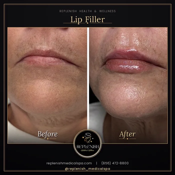 Lip filler before and after at Replenish