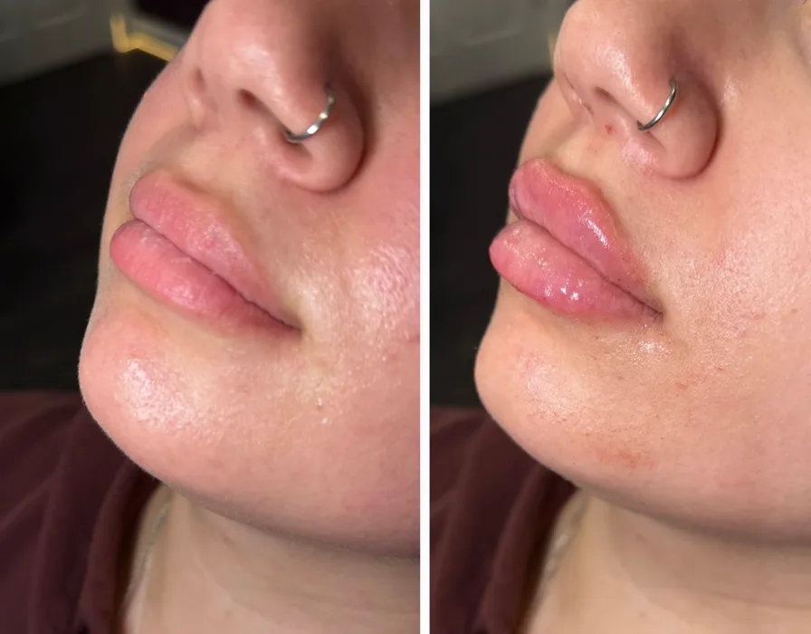 Lip filler profile before and after at Replenish