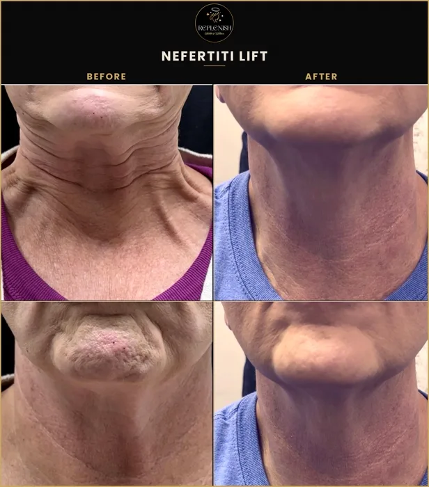 Nefertiti lift neck before and after at Replenish