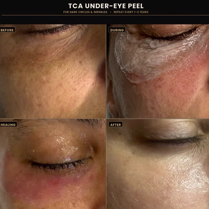 TCA under-eye peel before, during, and after at Replenish